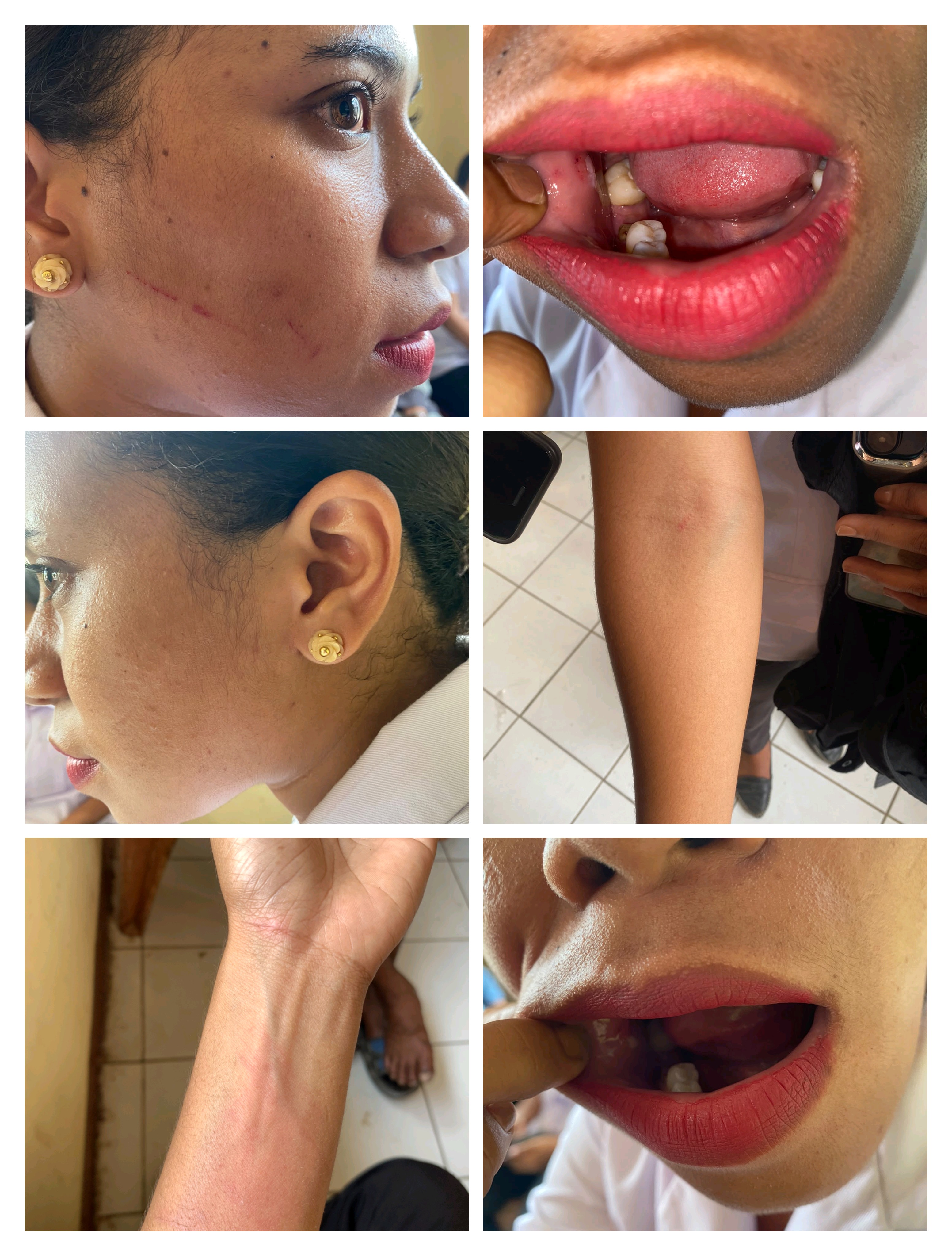 DIDUGA DIKEROYOK SAAT TANGANI PASIEN, DUA NAKES LAPOR POLRES SBD: ADA APA DI KODI BANGEDO?