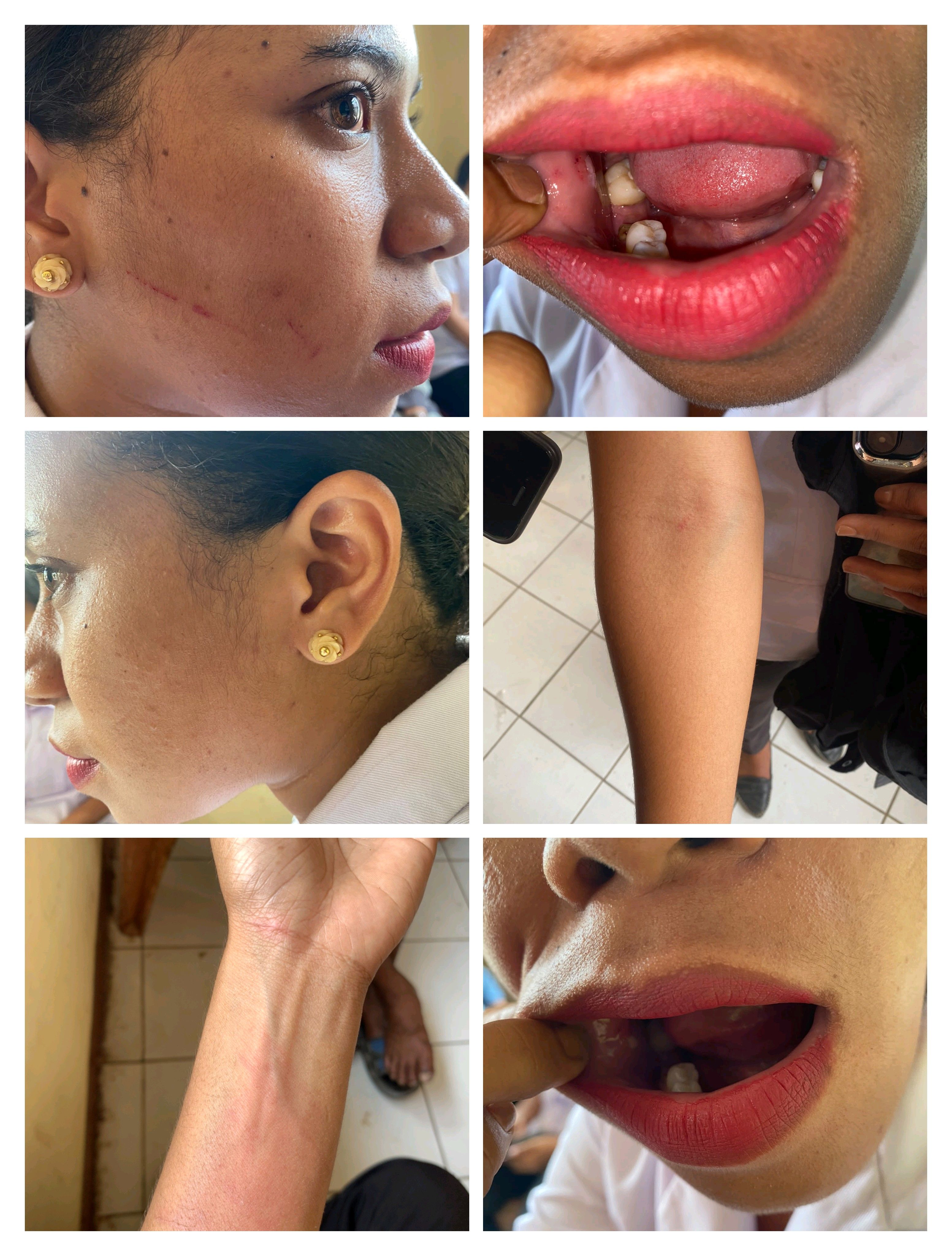 DIDUGA DIKEROYOK SAAT TANGANI PASIEN, DUA NAKES LAPOR POLRES SBD: ADA APA DI KODI BANGEDO?